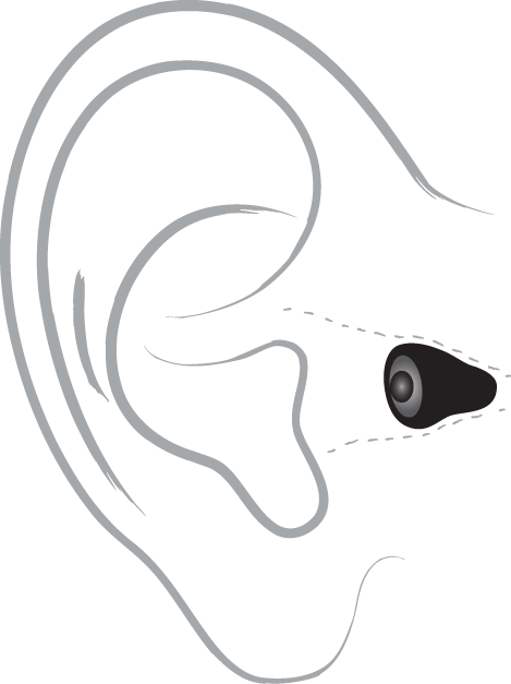 Invisible-in-the-Canal (IIC) Hearing Aids